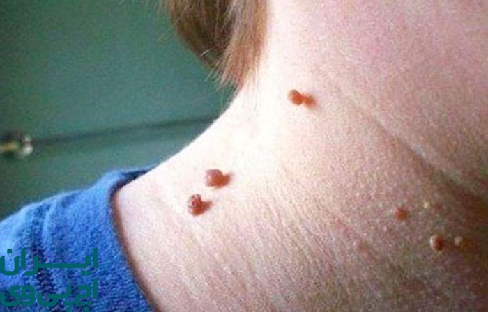 مدت‌ زمان ماندگاری و روند پیشرفت زگیل