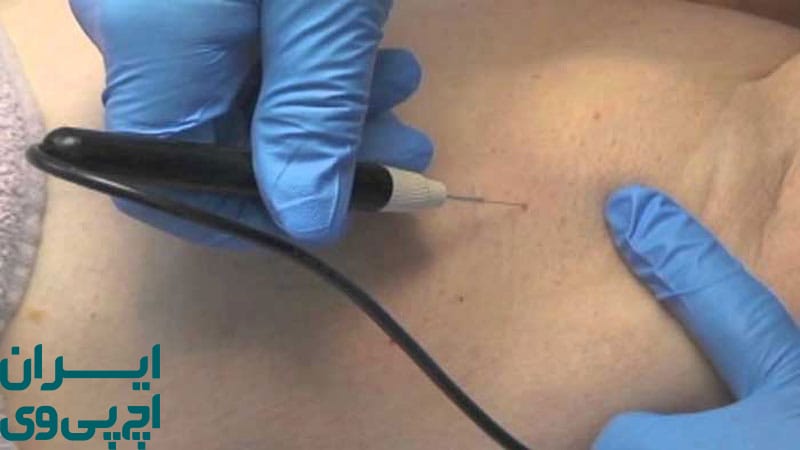 مراقبت‌ های پس از فریز HPV