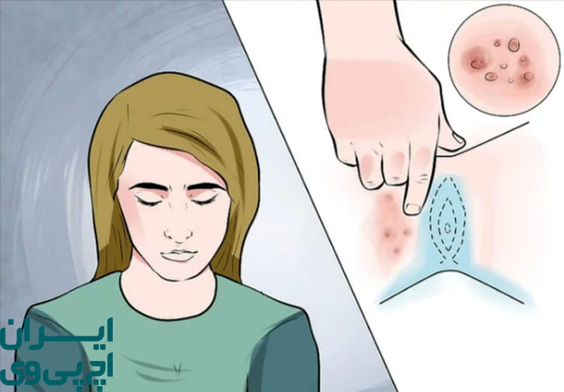 نقش مشاور در پذیرش بیماری HPV 