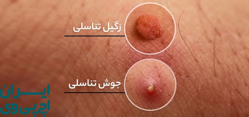 ویژگی‌ های ظاهری آکنه تناسلی در مقایسه با زگیل HPV
