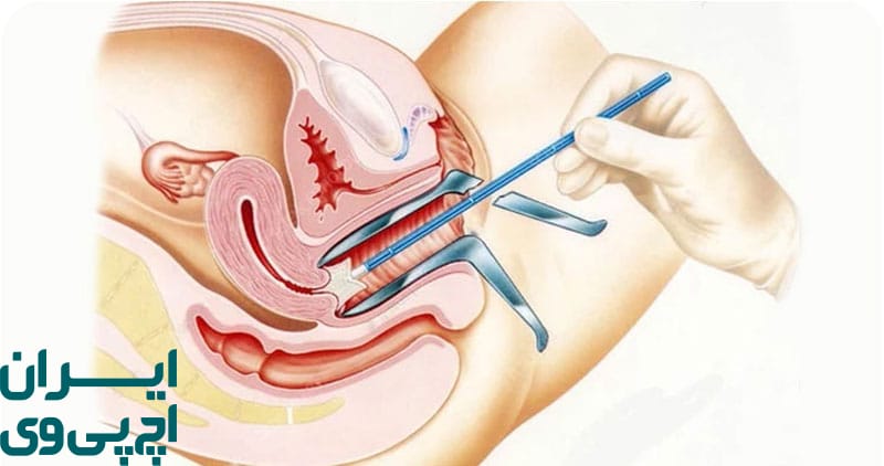 پاپ اسمیر چیست و چگونه انجام می‌شود؟