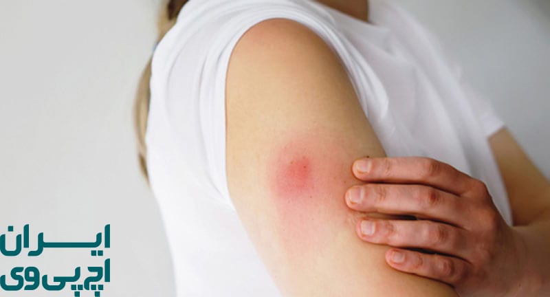 پرهیز از فعالیت سنگین پس از واکسن HPV