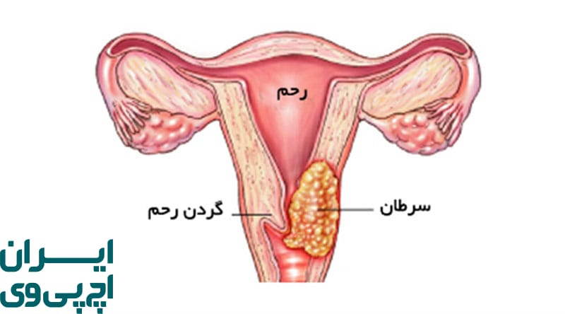 چگونه HPV موجب تغییرات سلولی در دهانه رحم می‌شود؟