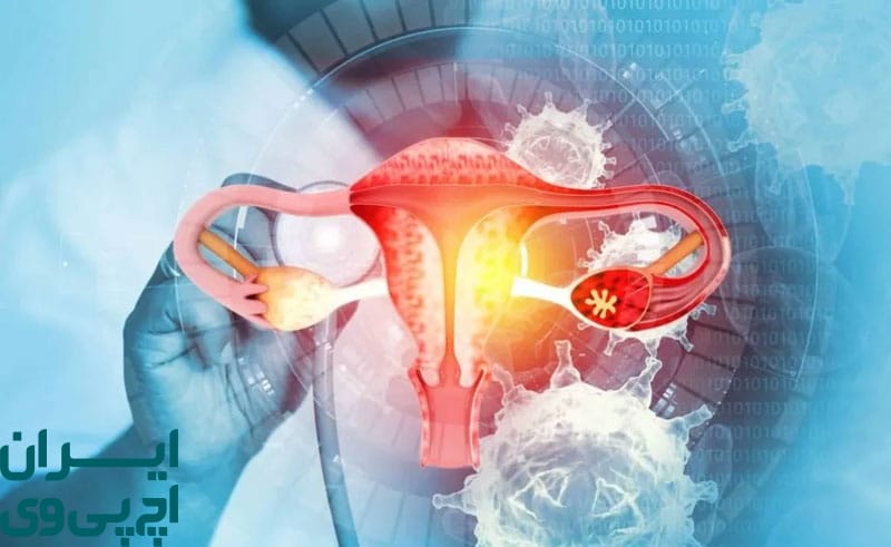 کدام نوع ویروس HPV با سرطان دهانه رحم مرتبط‌اند؟