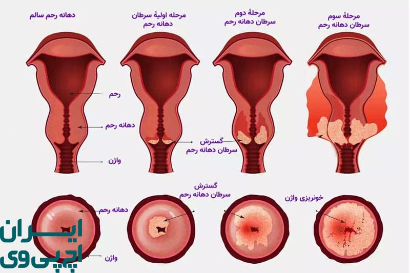 گونه‌های پرخطر HPV و سرطان دهانه رحم