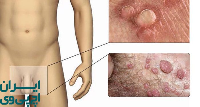 HPV در مردان بدون علائم