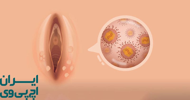 آیا HPV بدون زگیل نیز خطرناک است؟