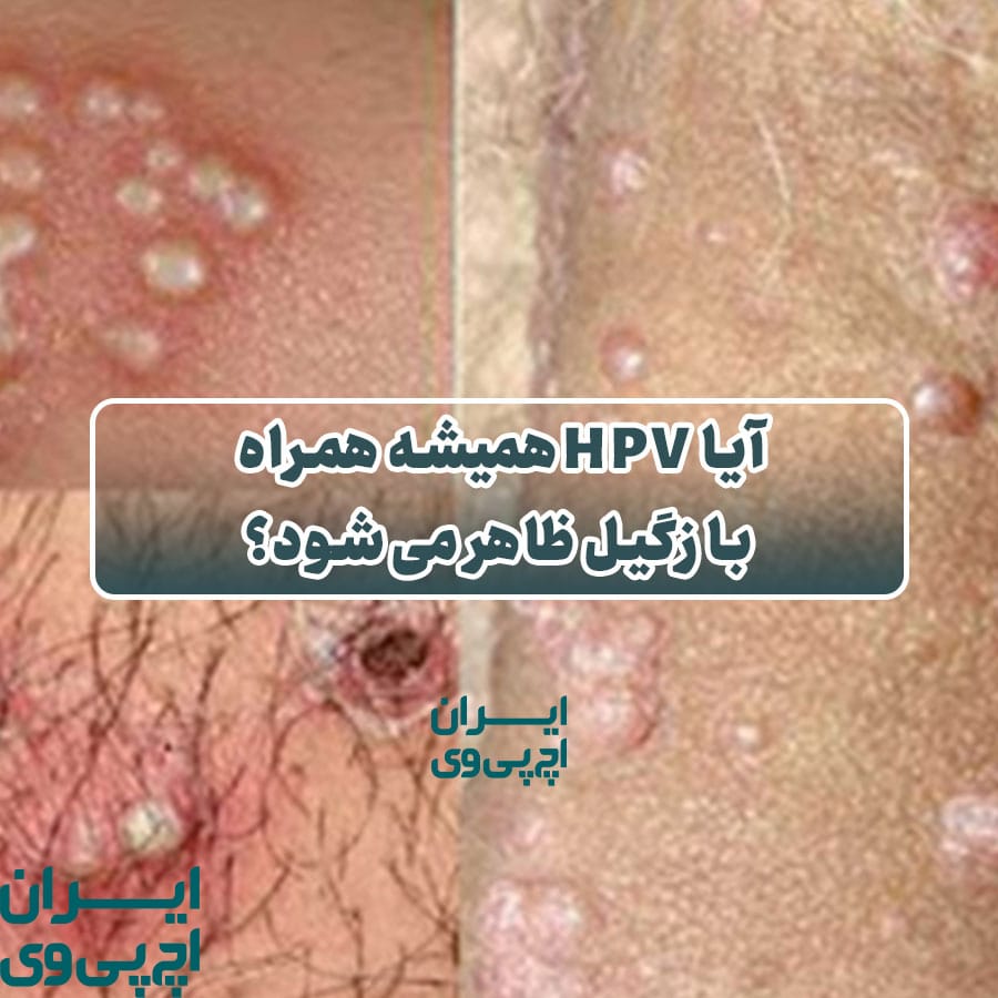 آیا HPV همیشه همراه با زگیل ظاهر می‌شود؟
