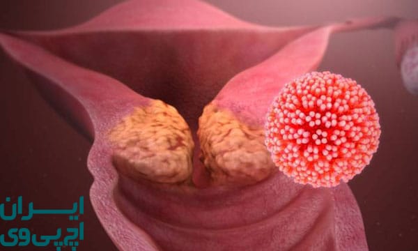 آیا رابطه دهانی یا مقعدی هم باعث HPV میشود؟