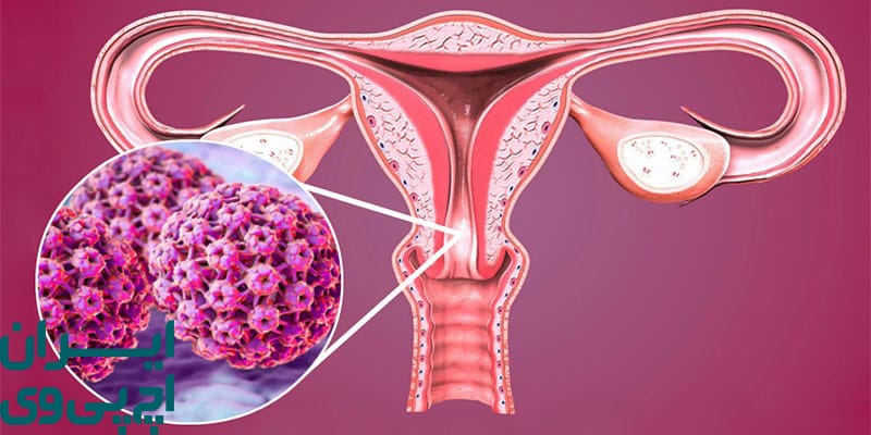 آیا همه انواع HPV خطرناک هستند و موجب سرطان می‌شوند؟