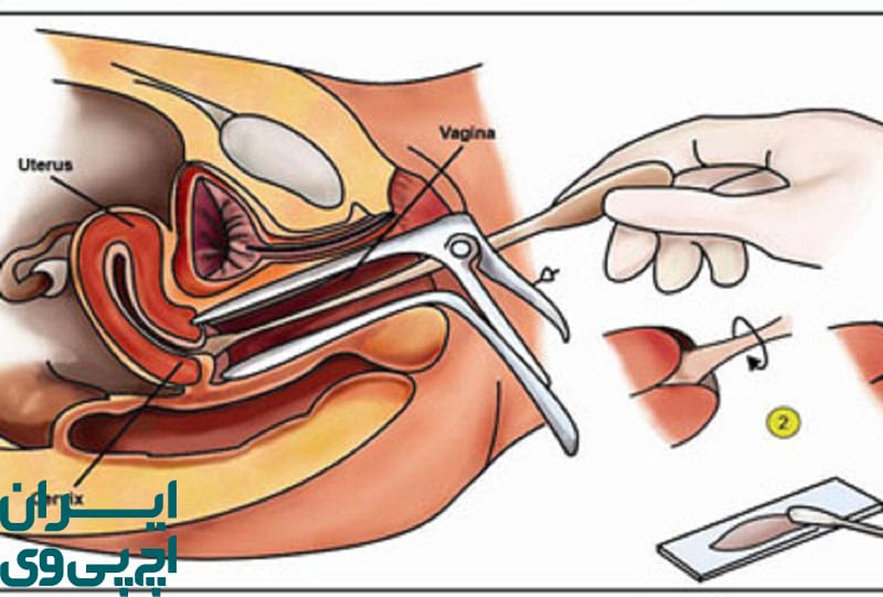 از کجا بفهمیم HPV از بدن خارج شده؟