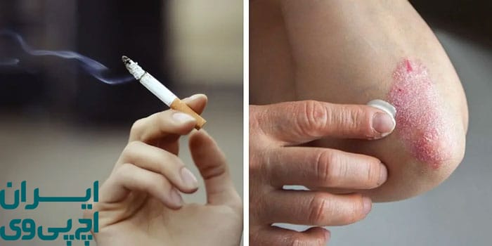 تأثیر مصرف سیگار بر عملکرد سیستم ایمنی در برابر HPV