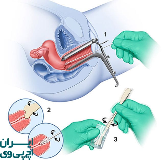 تست HPV چه چیزی را شناسایی می‌کند؟