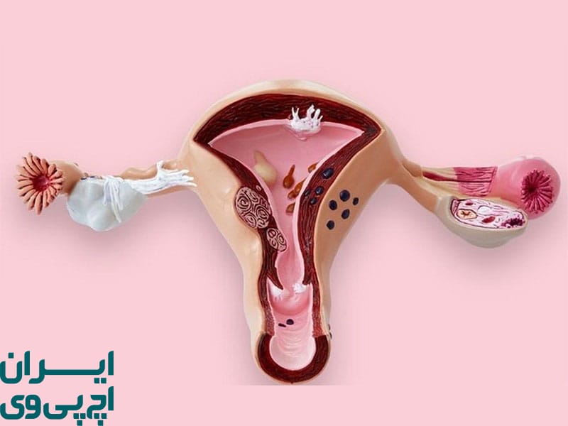 تغییرات هورمونی و تأثیر آن بر درمان HPV در زنان یائسه