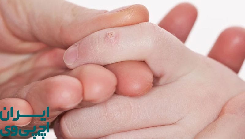 تفاوت‌های درمان HPV در کودکان نسبت به بزرگسالان