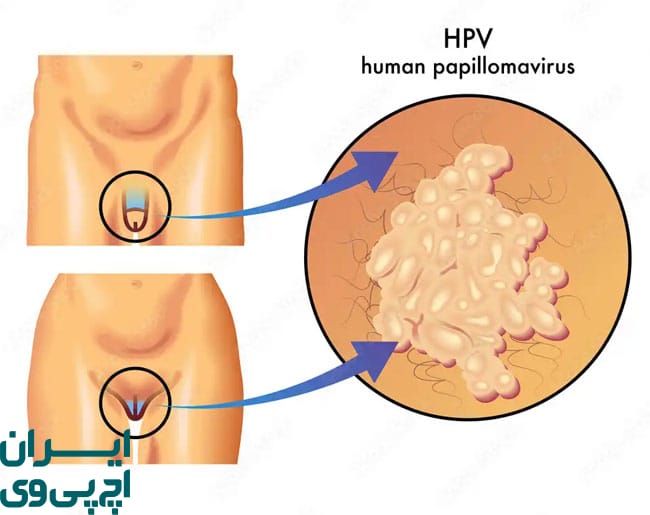 تقویت سیستم ایمنی برای پیشگیری از HPV