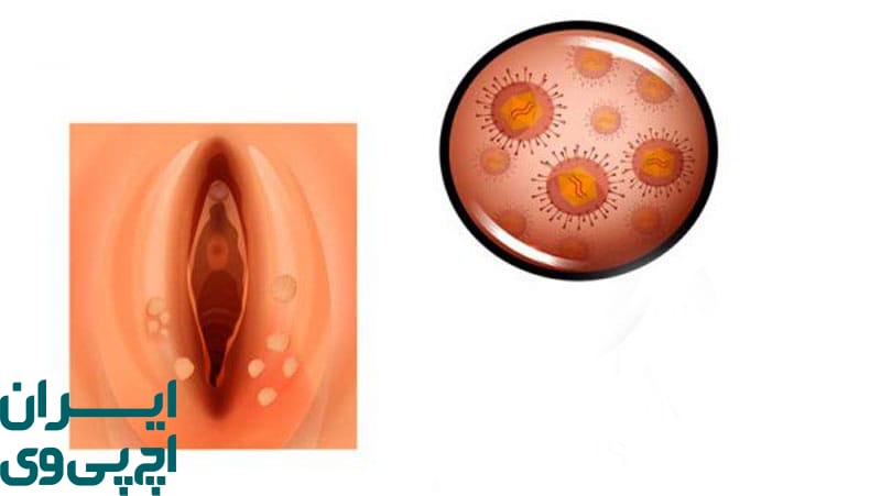 ساختار بدن زنان و نقش آن در افزایش خطر HPV