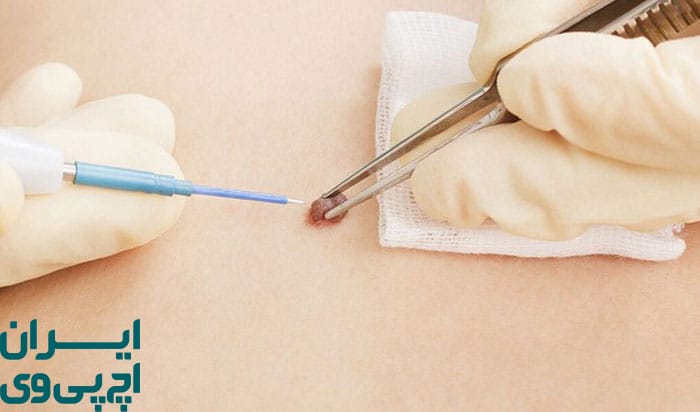 مزایا و محدودیت‌های درمان لیزری زگیل HPV