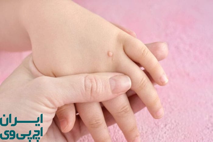 مسیرهای انتقال HPV در کودکان و نوجوانان