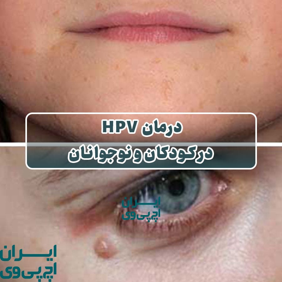 درمان HPV در کودکان و نوجوانان