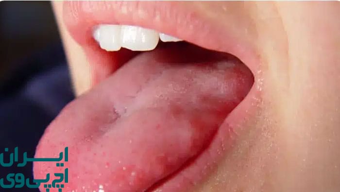 نقش انتقال دهانی در شیوع HPV