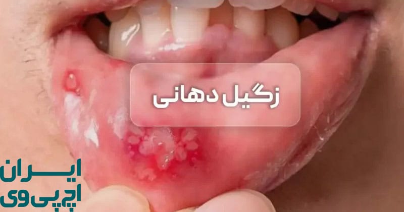 نقش سویه‌ های پرخطر HPV در آغاز تغییرات سرطانی دهان