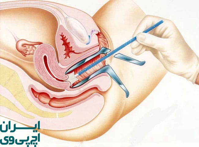 هدف اصلی تست پاپ اسمیر و تفاوت آن با تست HPV DNA