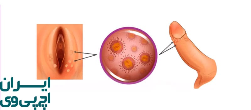 چه عواملی باعث بروز یا عدم بروز زگیل می‌شوند؟