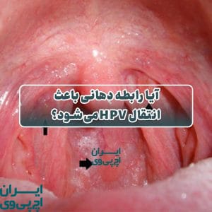 آیا رابطه دهانی باعث انتقال HPV می‌شود؟