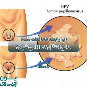 آیا رابطه محافظت‌شده مانع انتقال HPV می‌شود؟