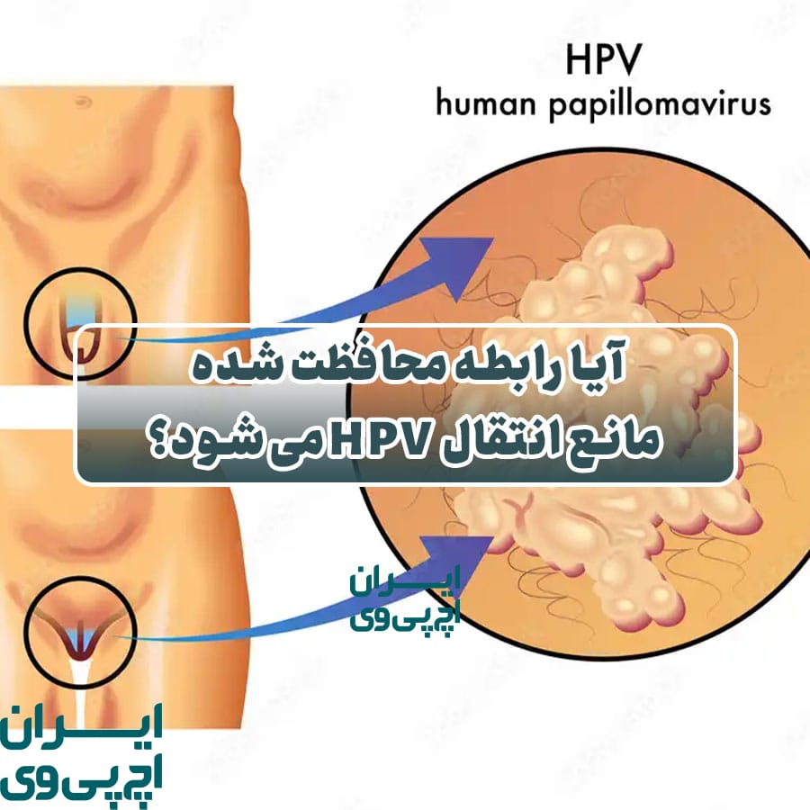 آیا رابطه محافظت‌شده مانع انتقال HPV می‌شود؟