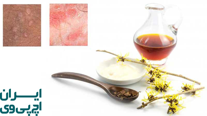 اثر مستقیم گیاهان بر زگیل‌ های HPV