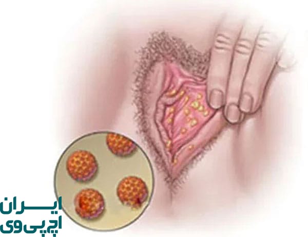 استفاده از تست‌ های آزمایشگاهی HPV