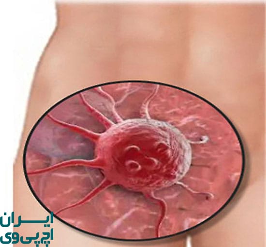 انتخاب پماد مناسب بر اساس محل زگیل