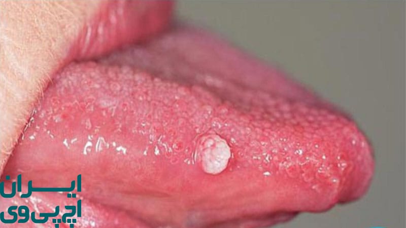 انواع HPV مرتبط با عفونت‌ های دهانی