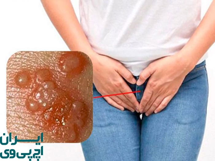 اهمیت مراقبت‌ های پس از درمان HPV برای جلوگیری از عود