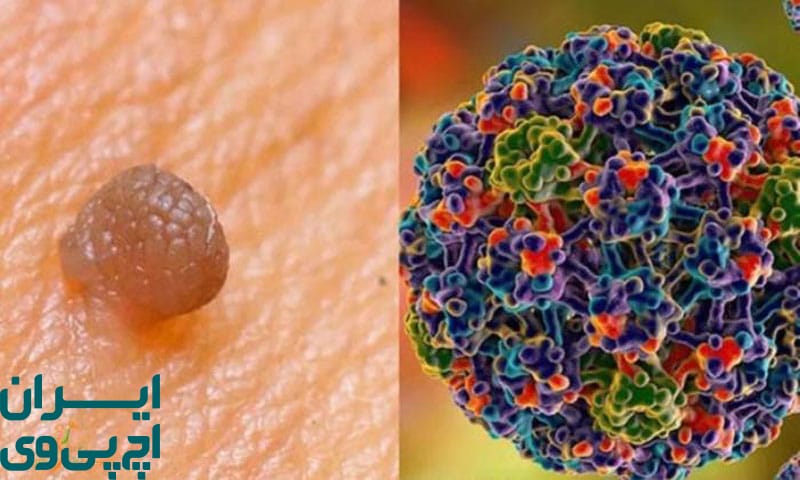 بازگشت برخی علائم پس از درمان ویروس HPV