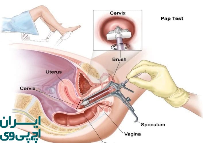 بررسی نشانه‌ های عمومی HPV در سلامت بدن