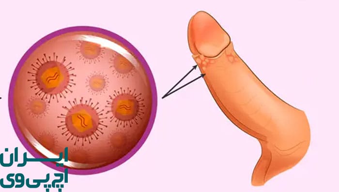 تأثیر ختنه بر انتقال HPV به شریک جنسی