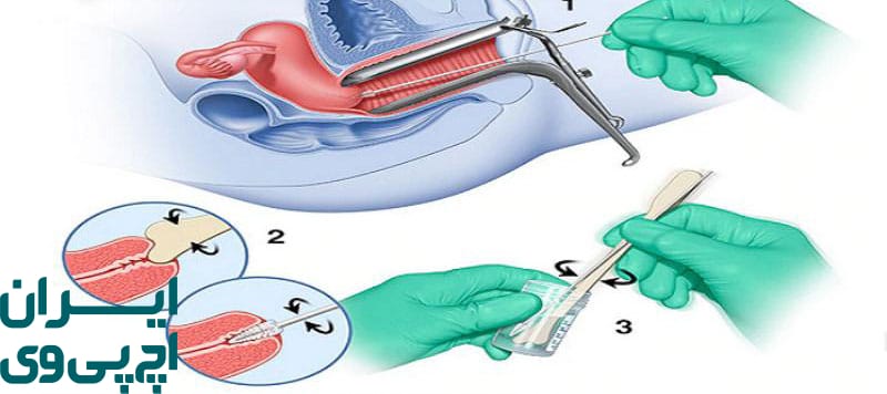 تایید و ارزیابی دقیق‌تر وضعیت ویروس HPV