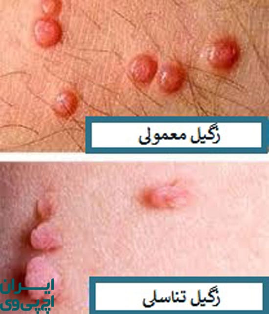 تفاوت زگیل تناسلی و زگیل پوستی در محل ایجاد