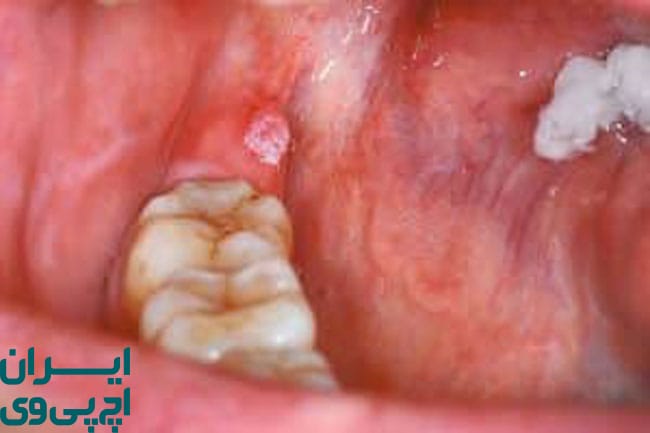 خطر ابتلا به سرطان در HPV دهانی