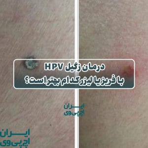 درمان زگیل HPV با فریز یا لیزر کدام بهتر است؟