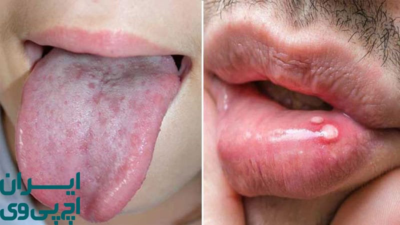 رابطه دهانی و مسیر انتقال ویروس HPV