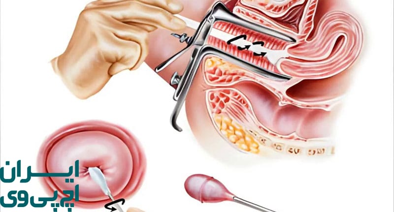 رابطه پاپ اسمیر با درمان HPV