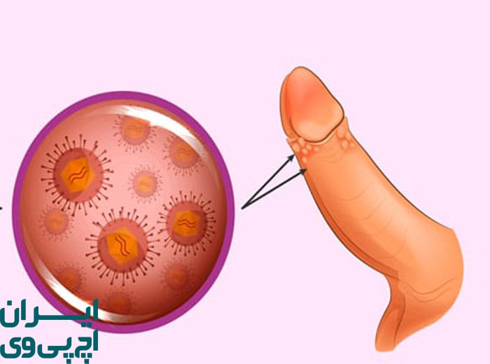 سرطان‌ های مرتبط با HPV در مردان