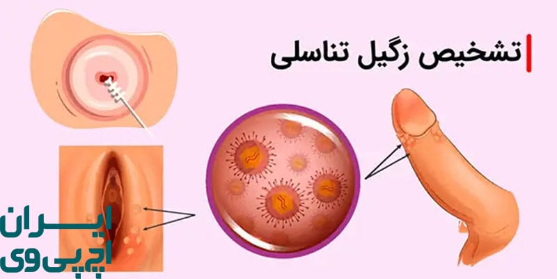 شناخت علائم ظاهری زگیل تناسلی