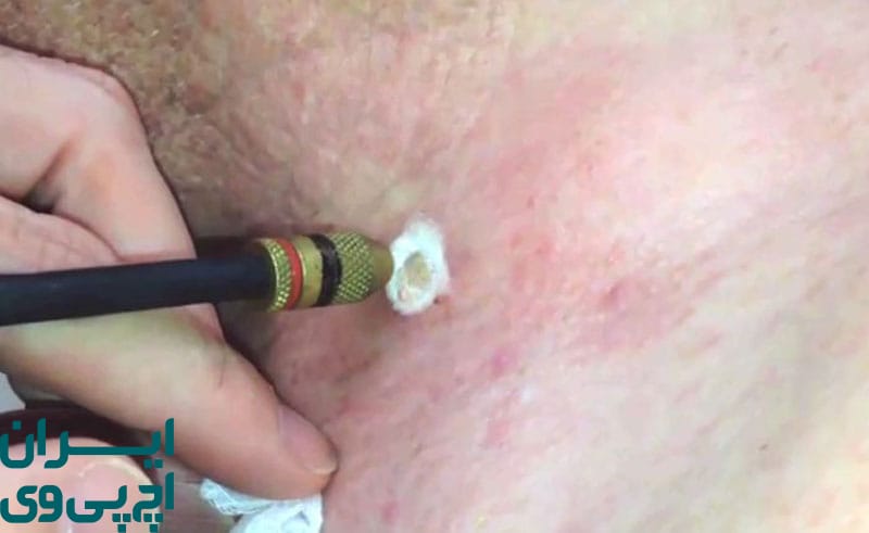 فریز کردن زگیل HPV چگونه عمل می‌کند؟