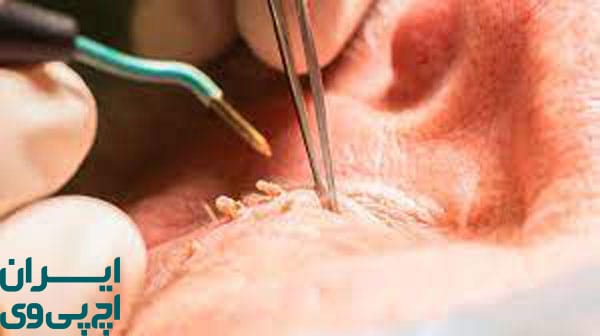 لیزر درمانی زگیل HPV