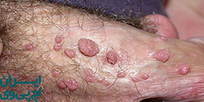 ماهیت ویروس HPV و زگیل تناسلی در مردان